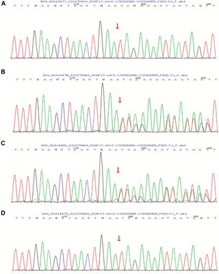 Case Report: A Deletion Variant in the DCAF17 Gene Underlying Woodhouse-Sakati Syndrome in a Chinese Consanguineous Family